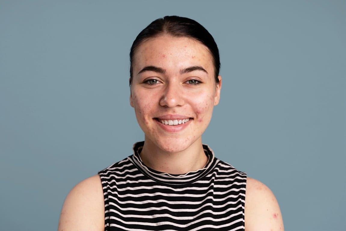 AI blemish remover before photo - selfie with small acne spots and blemishes